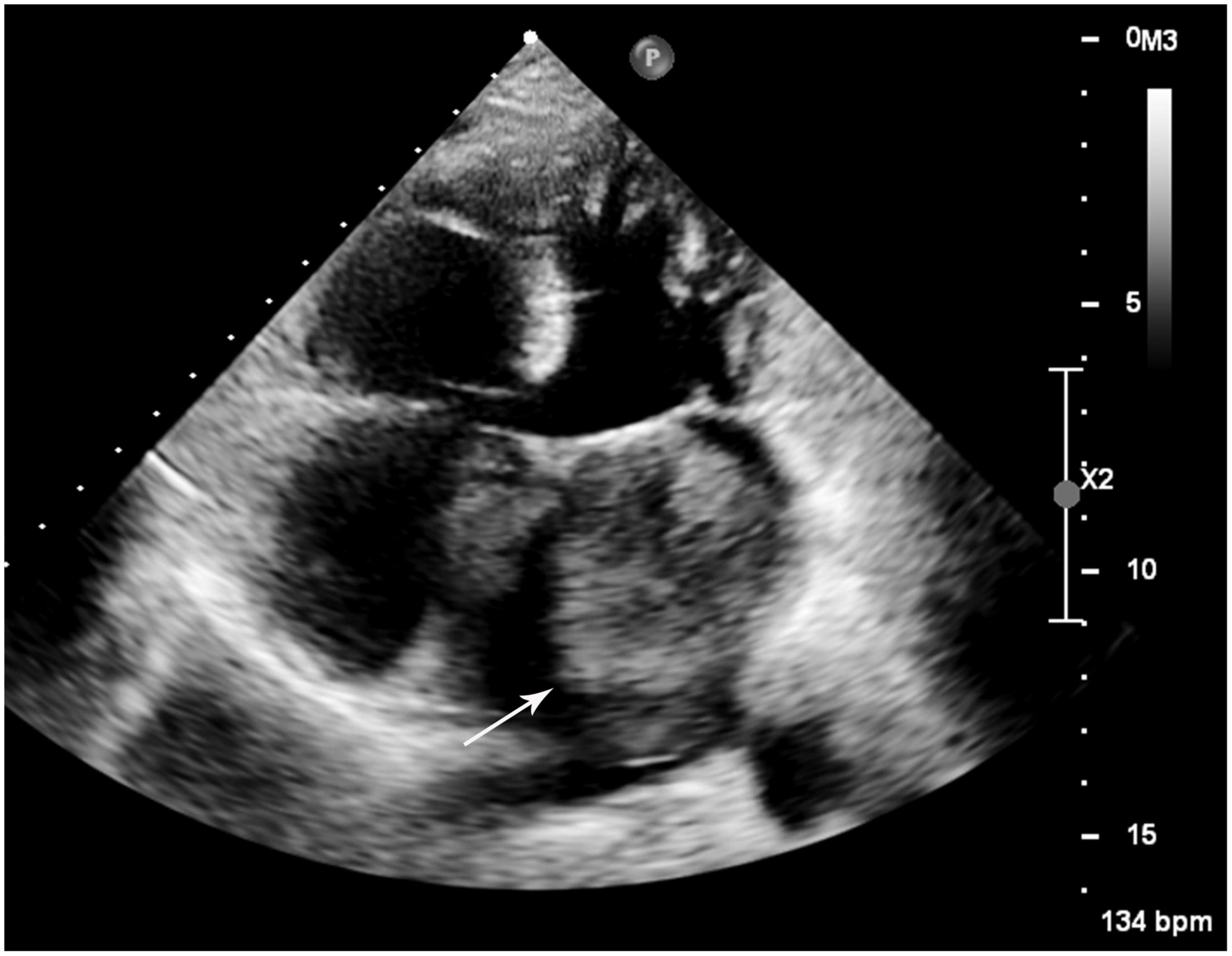 Case report: The diagnostic challenge of primary cardiac intimal sarcoma